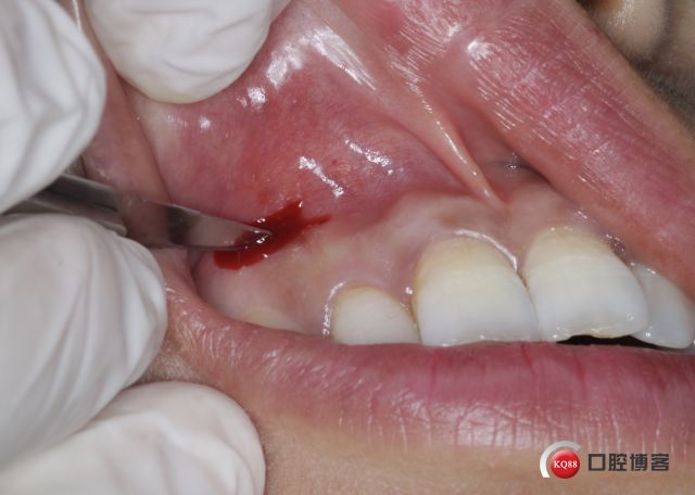 上前牙根尖手术病例