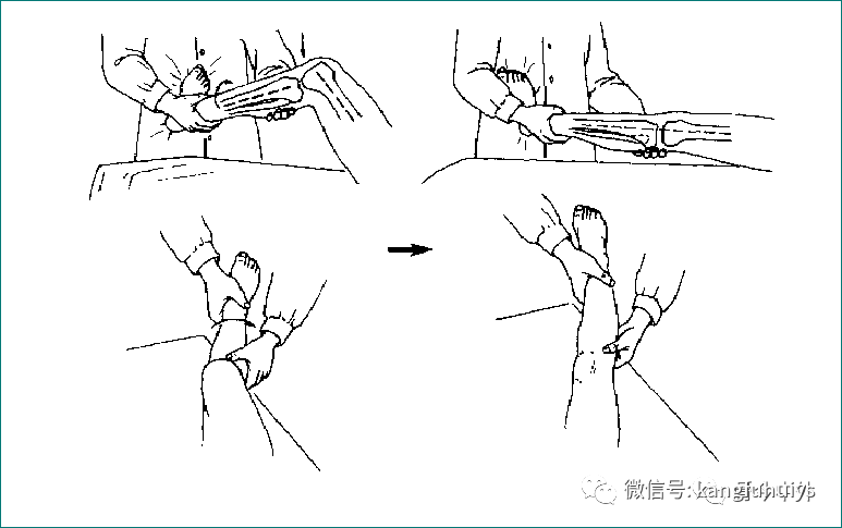 常见的足部畸形2跟腱损伤检查3踝部前抽屉试验