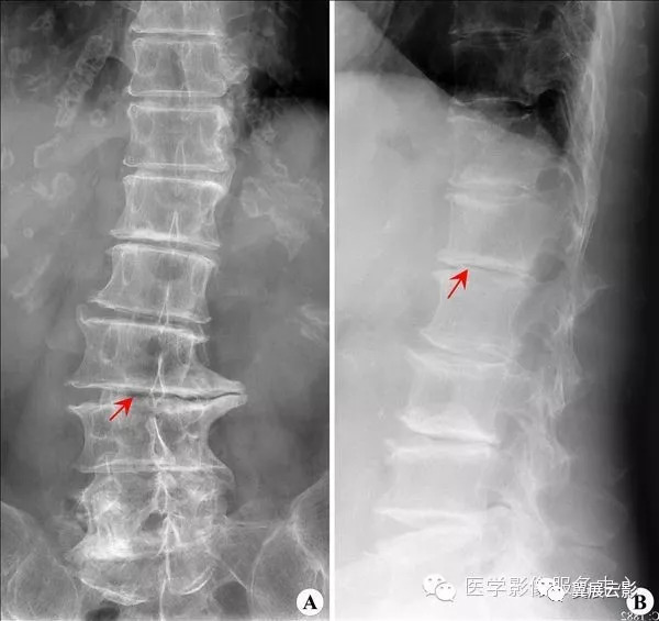 【影像表現】:x線腰椎正位(a)示腰段脊柱側彎,腰3/4椎間盤右寬左窄,並