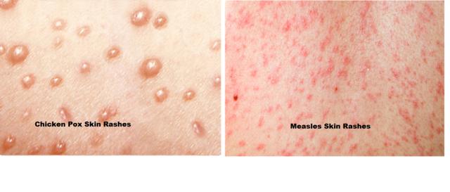 过敏和水痘的区别图片图片