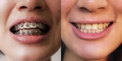 一键康:持续舔牙超过5秒钟就会让牙齿变歪?