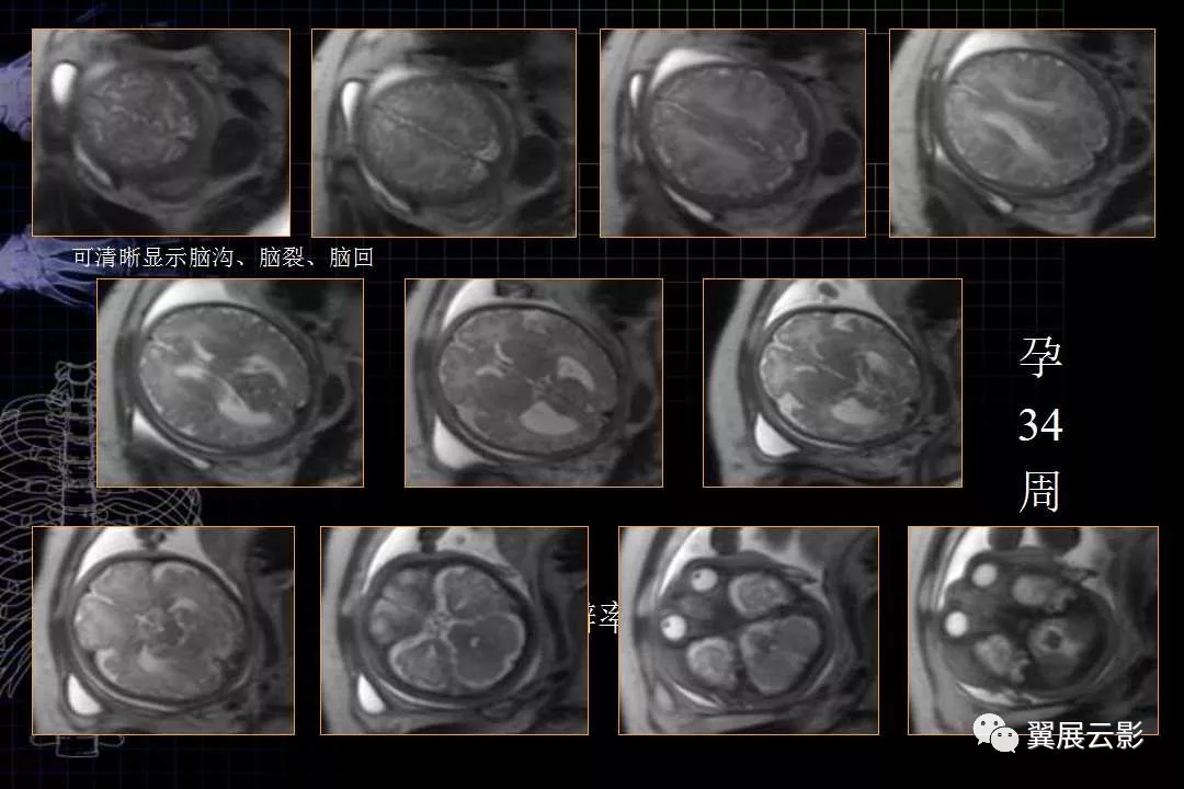 胎兒磁共振解剖圖譜