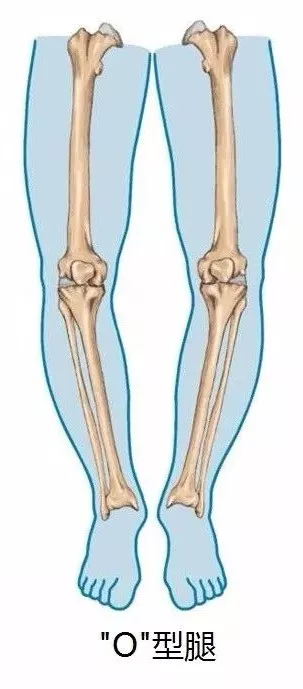 导致o型腿的不良站姿: 内八字站立,侧偏站立(稍息姿势站立),两腿交叉