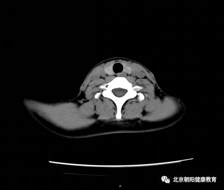 mri可以觀察較大的甲狀腺結節與周圍結構的關係及頸部淋巴結.