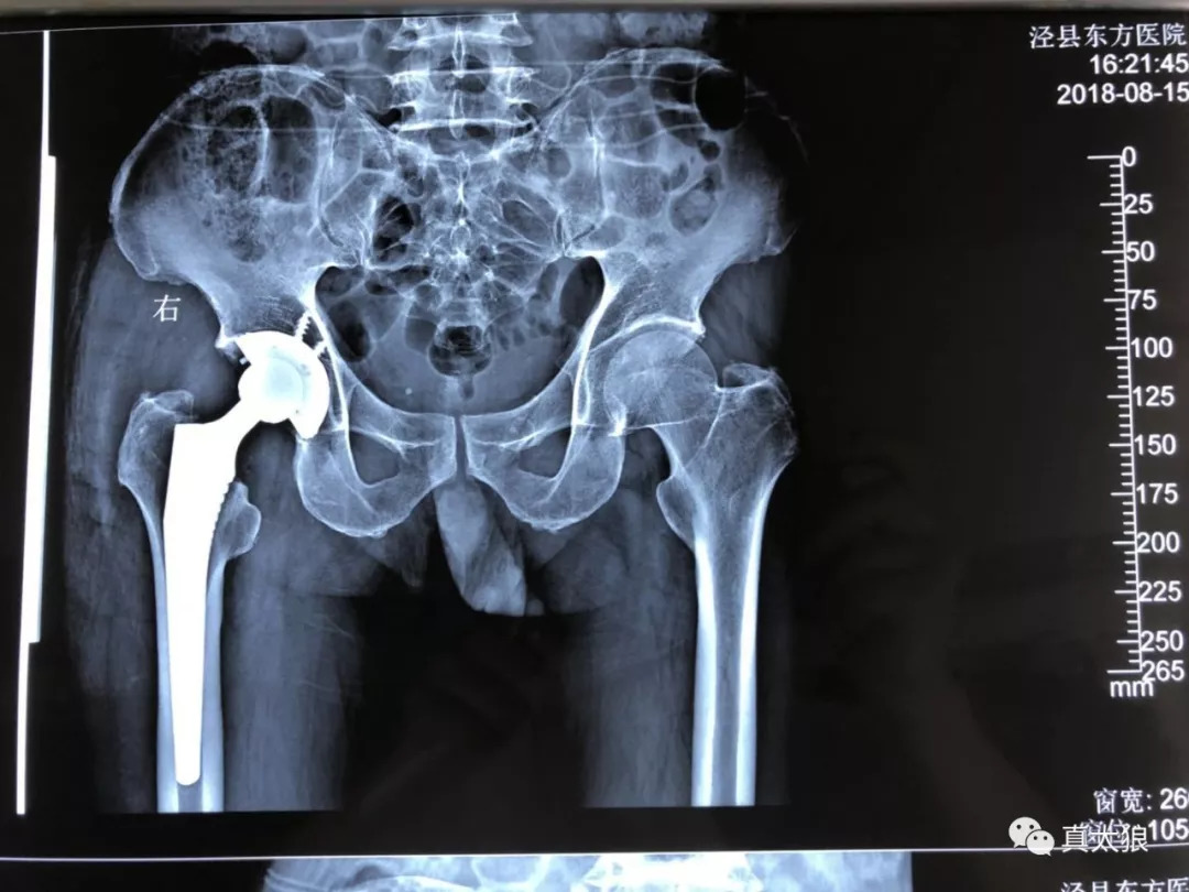 手术前骨折摄片门诊检查摄片示:股骨颈骨折,骨科汪主任团队经仔细体格
