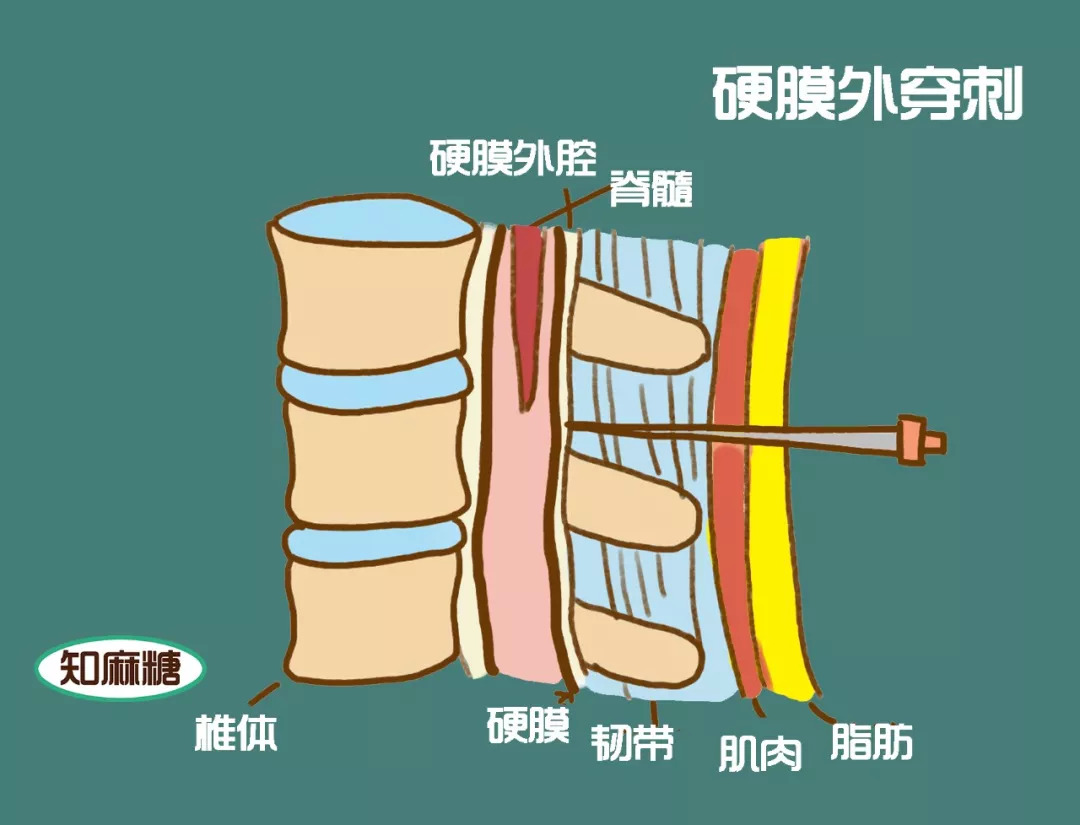 硬膜外麻醉解剖图图片