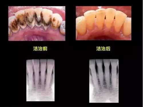 牙结石有黑色的吗图片