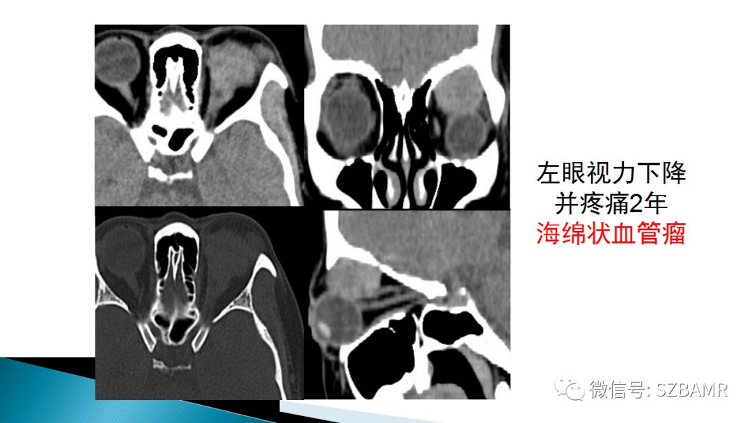 眼眶常见肿瘤影像表现