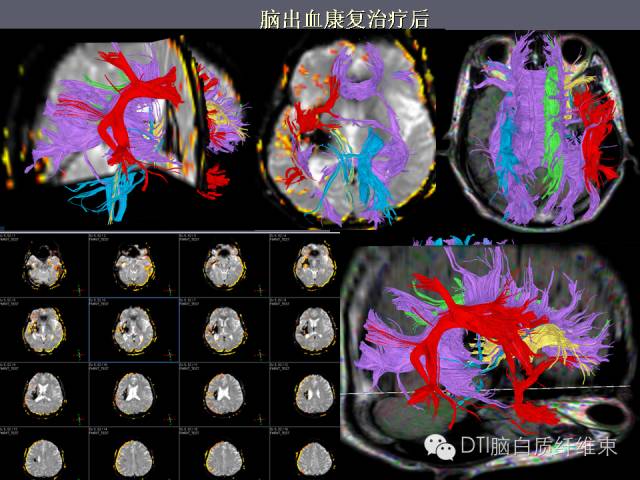 磁共振dti成像-投射纤维