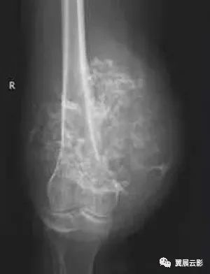 【病例】股骨下段骨质致密度欠均匀,有溶骨性骨质破坏,codman三角形成