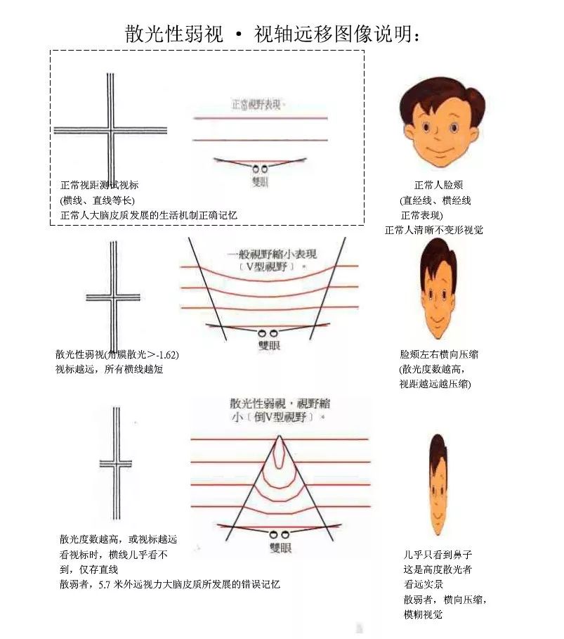 家長往往,被這種原因導致的弱視忽略_散光