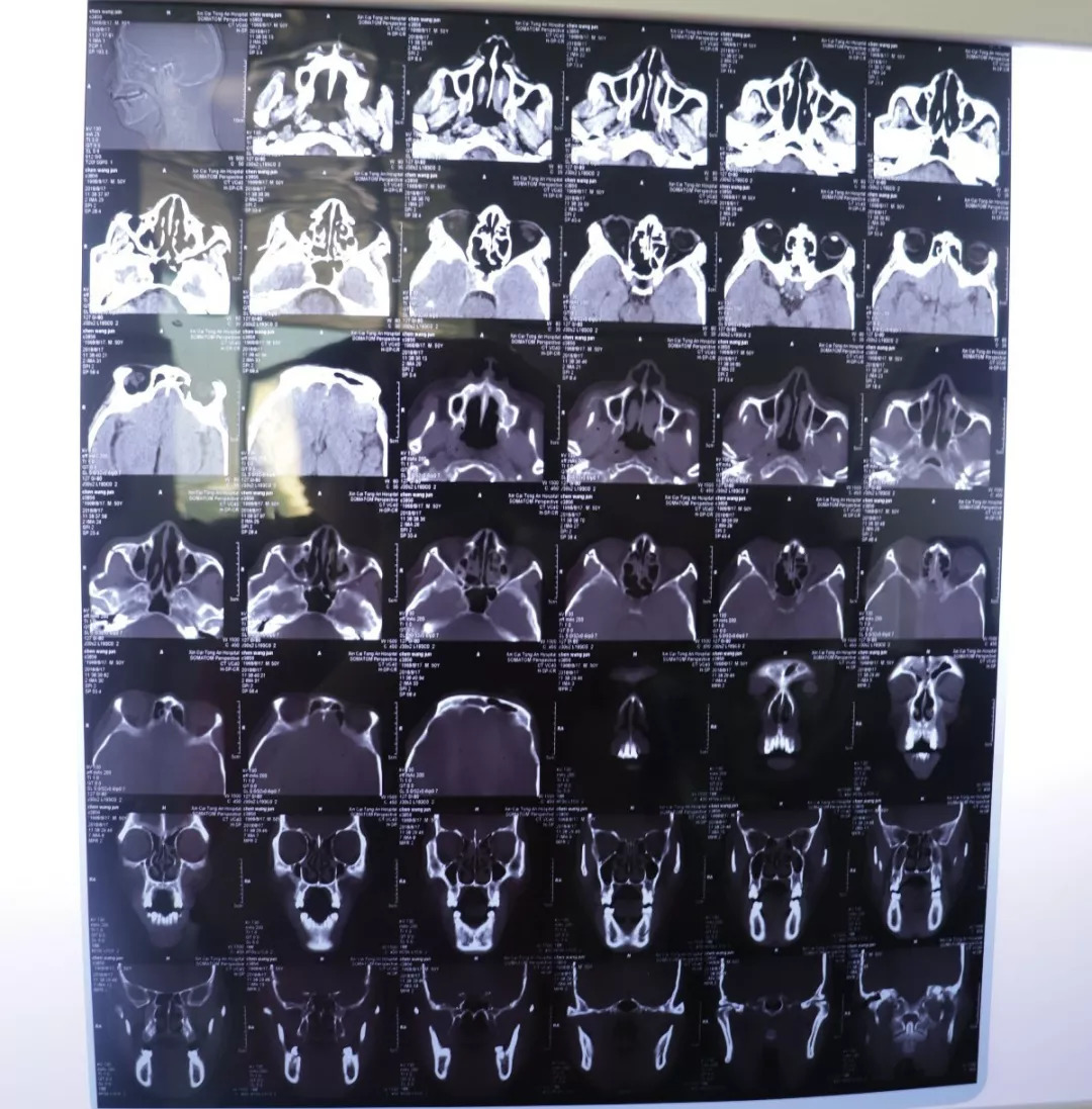颧骨ct断层解剖骨窗图片