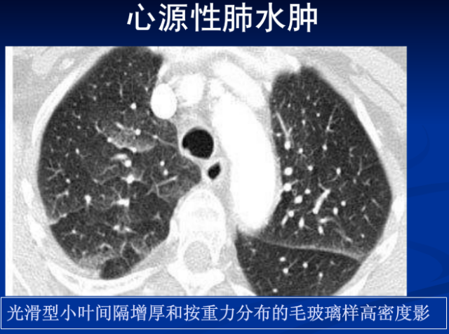 不同類型肺水腫的ct表現