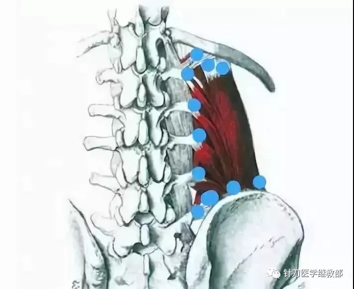 腰三横突综合症的针刀治疗 腰椎横突疼痛临床治疗的肌肉思考