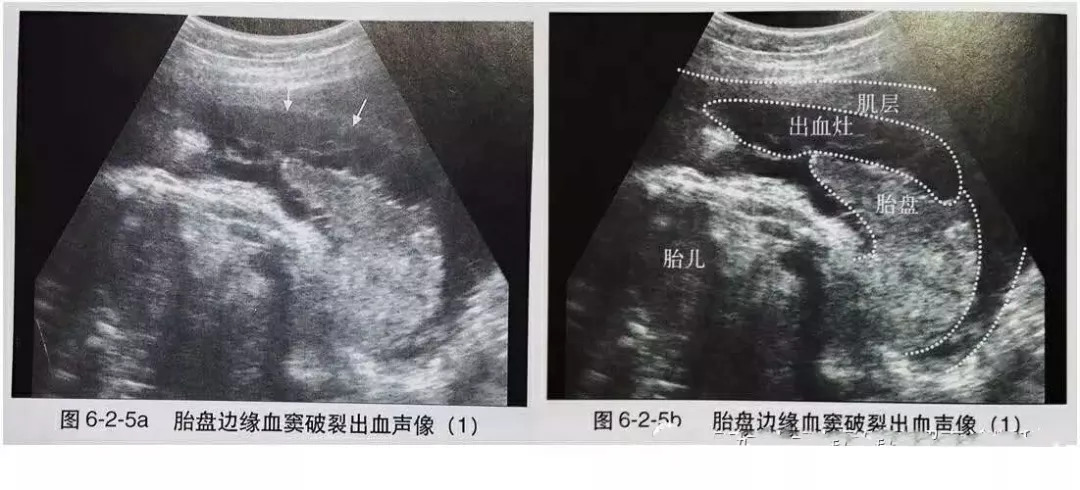 胎盘早剥超声诊断图片