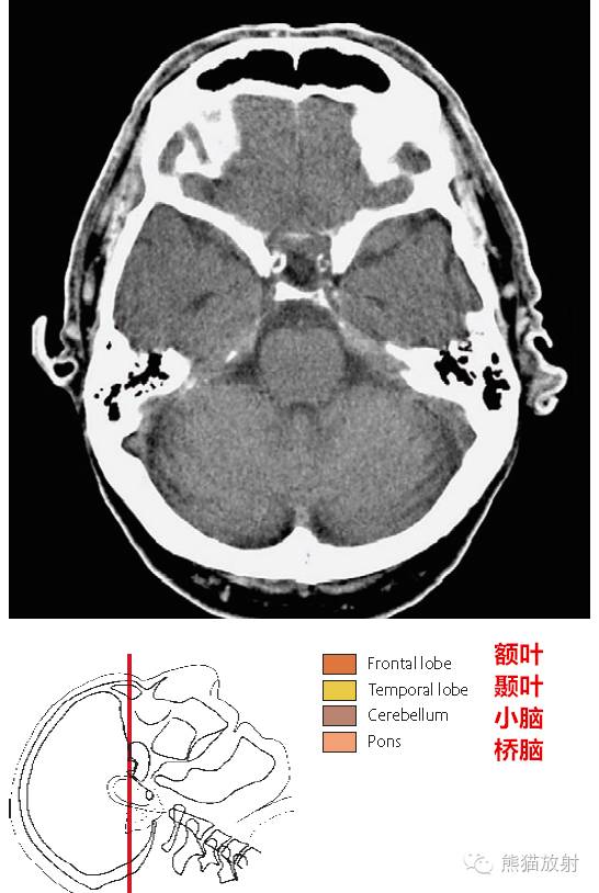 解剖入門顱腦ct斷層中英文對照