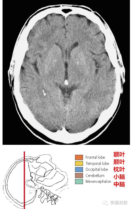 头颅ct小脑位置图片
