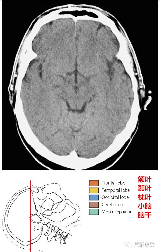 解剖入門顱腦ct斷層中英文對照