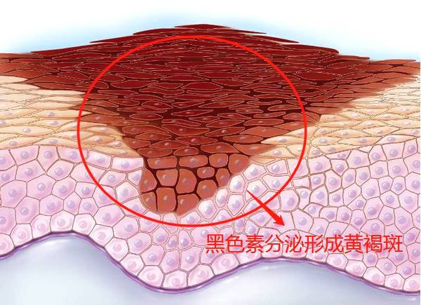 黑色素一般分布在真皮层和表皮层中,当脸上出现了几颗斑点,实际上皮肤