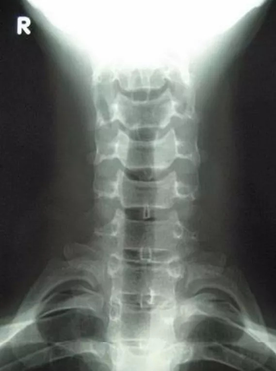 颈椎双斜位x光片图片