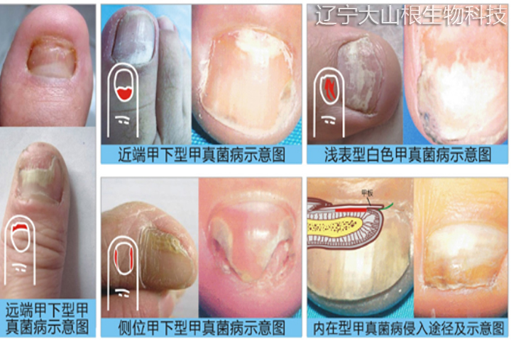 灰指甲分类图片