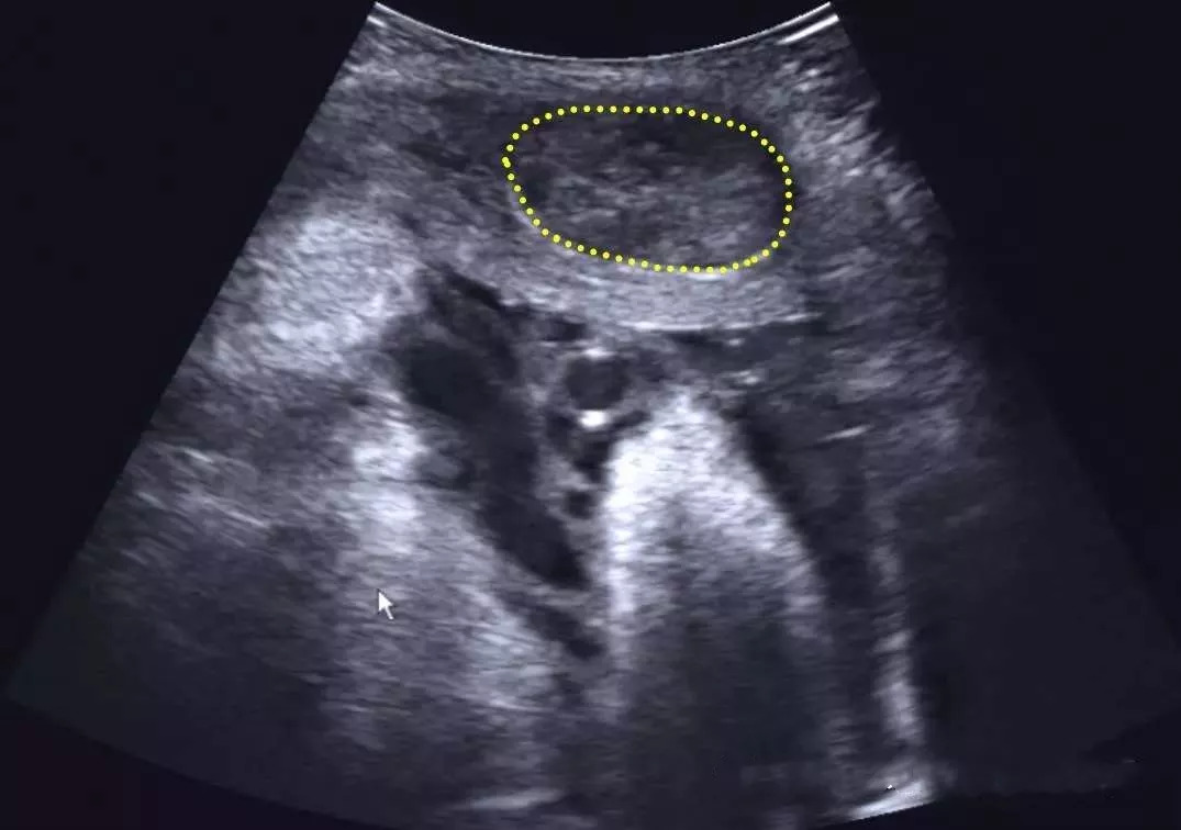 胎盘早剥超声诊断图片