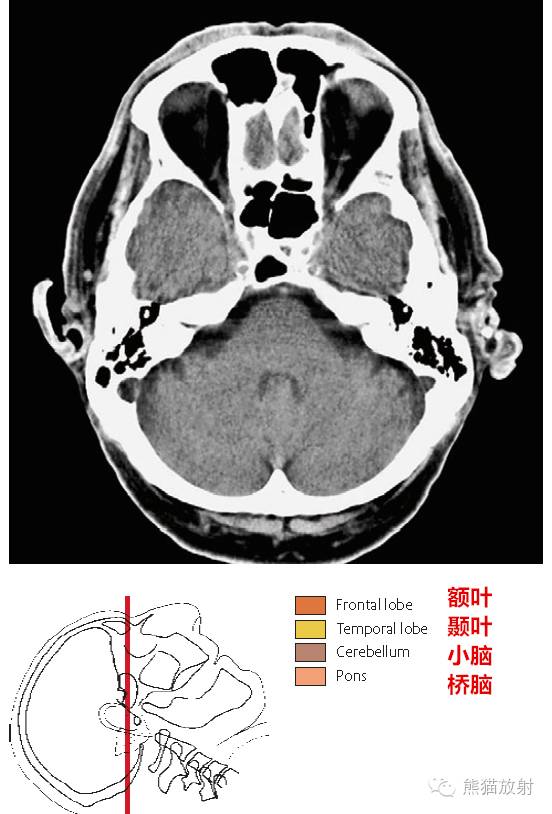 小脑扁桃体ct解剖图片