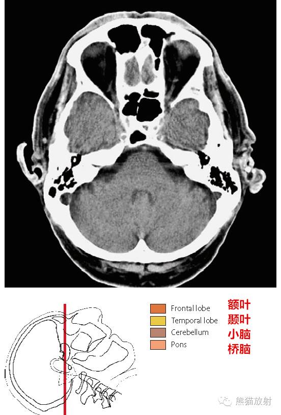 头颅ct扫描定位线图片图片