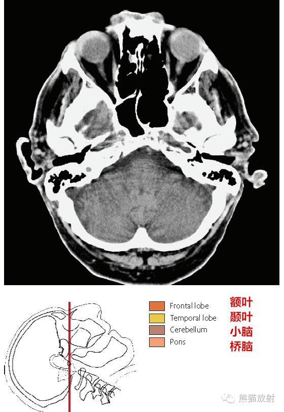 解剖入門顱腦ct斷層中英文對照