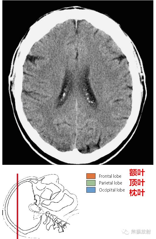 解剖入門顱腦ct斷層中英文對照
