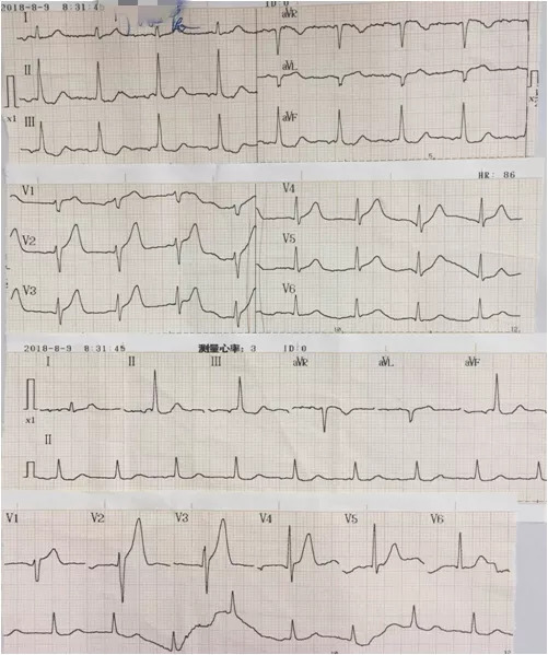 dewinter心电图图片