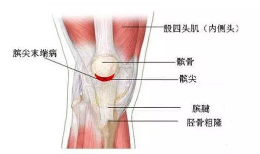 胫骨粗隆疼痛什么原因图片