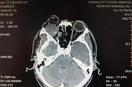 眼科成功實施一例眼眶內巨大腫瘤摘除術,助患者重拾自信