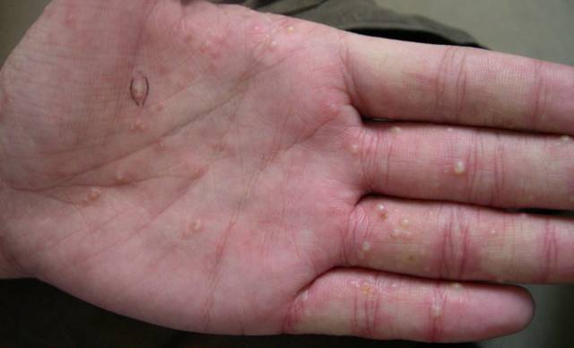 汗疱疹是一种发生于手掌,手指侧面,指端皮肤的复发性水疱病,属于湿疹