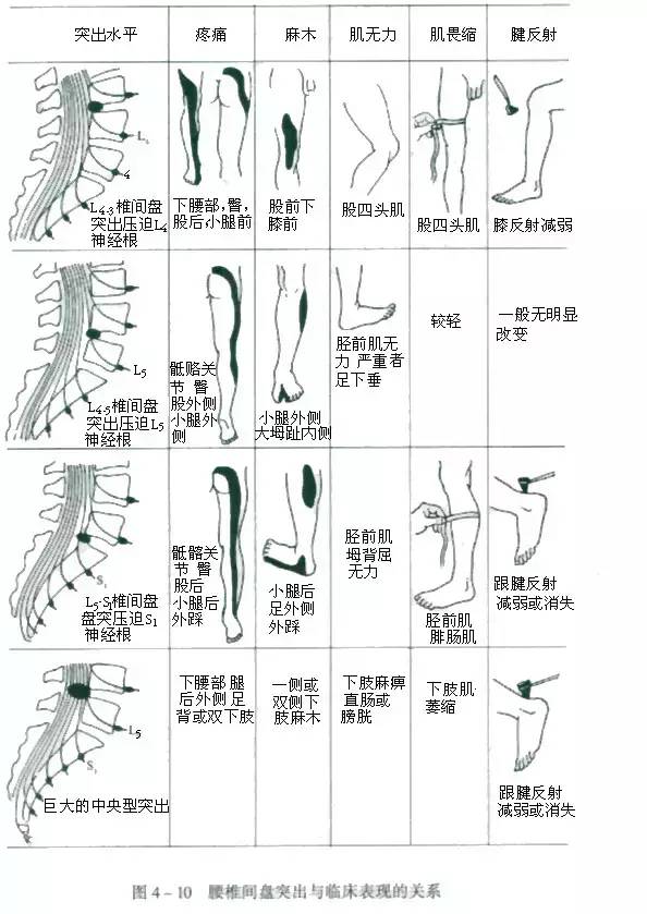 【璞薇分享】腰椎間盤突出的發病原因,臨床表現,曲度變化,一文圖解