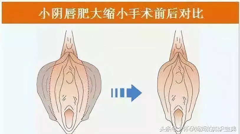 阴蒂肥大在确诊前必须与男性假两性畸形及女性假两性畸形相鉴别