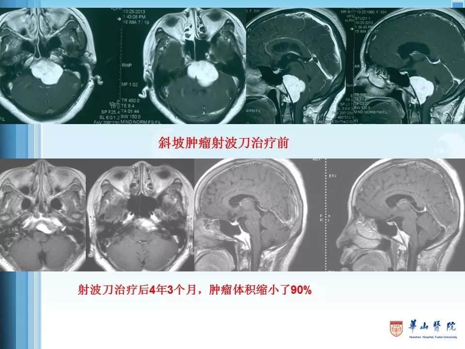 8月29日钟平王恩敏射波刀十年磨一剑多学科融合与创新治疗