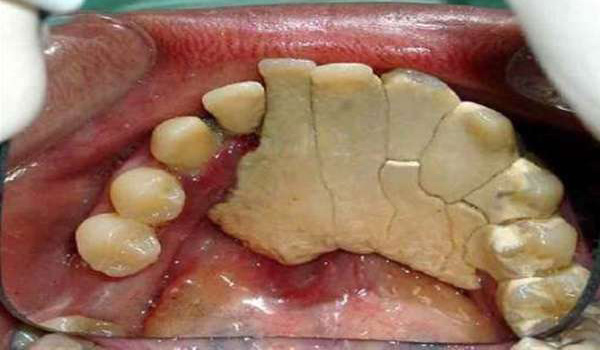 牙结石形成的原因及其分级程度
