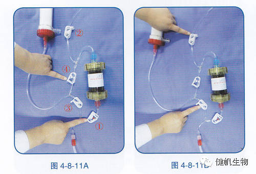 血液灌流器连接图图片