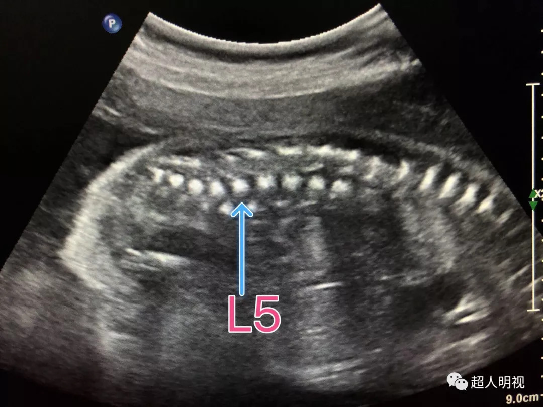 胎儿半椎体图片