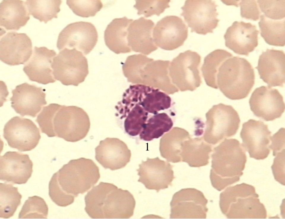 晚期粒细胞的核嗜酸:嗜酸性颗粒粗大均一呈桔红色,核平时喜欢分两叶