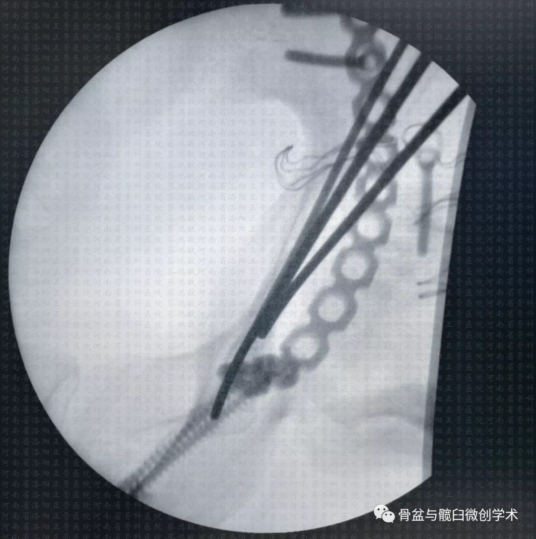 在哪兒跌倒從哪兒站起來一例髖臼t形骨折的手術治療