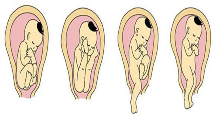 孕9月胎兒什麼姿勢?決定了順產或剖腹產