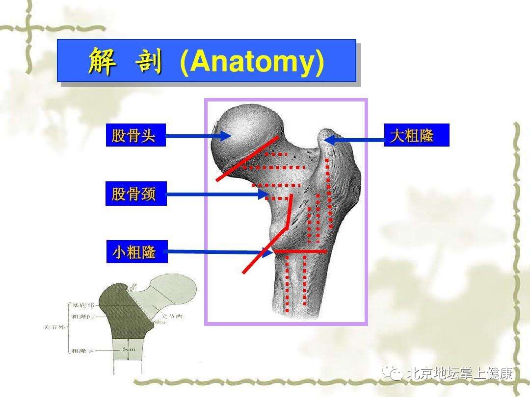 股骨粗隆间骨折部位图图片