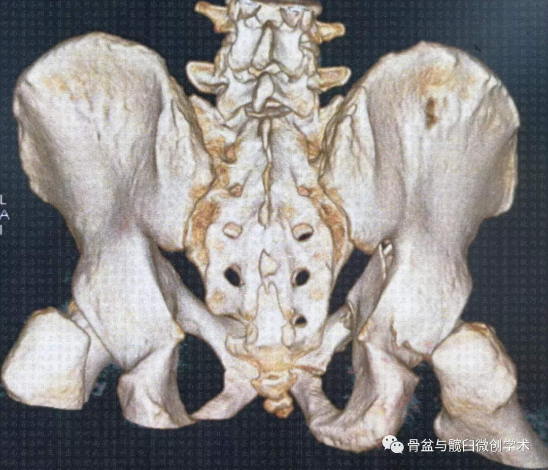 在哪兒跌倒從哪兒站起來一例髖臼t形骨折的手術治療