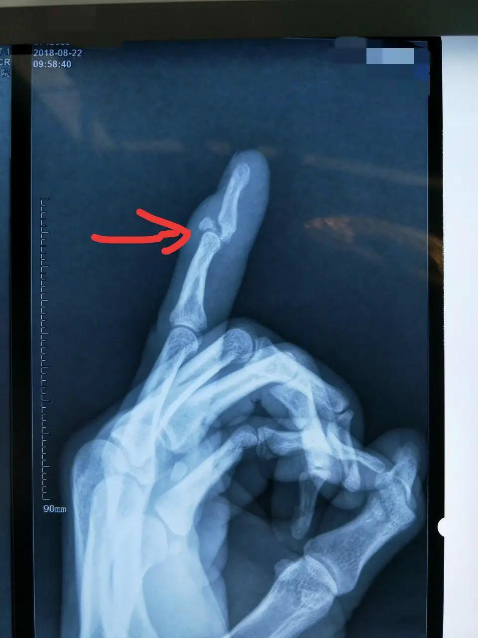 手指关节错位的表现图片