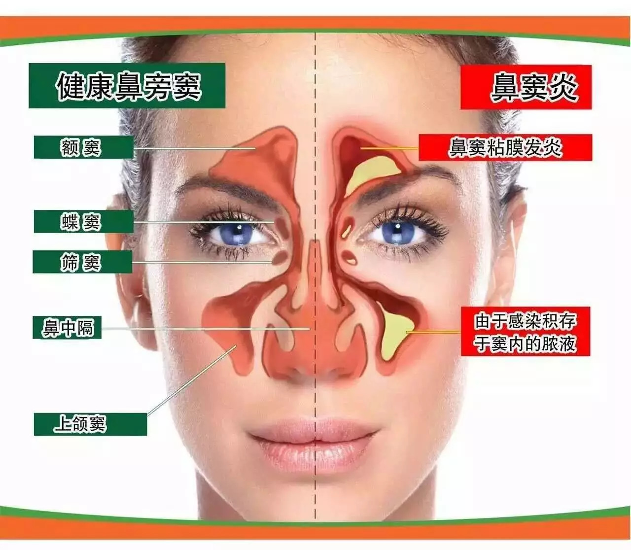 鼻窦炎位置图片图片