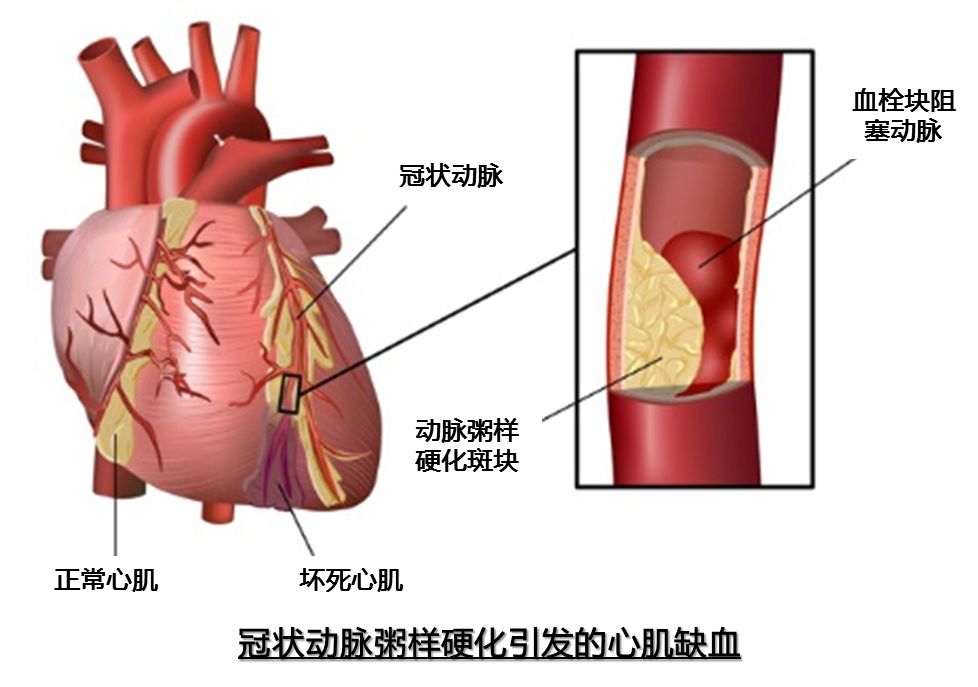 冠状动脉位置图片