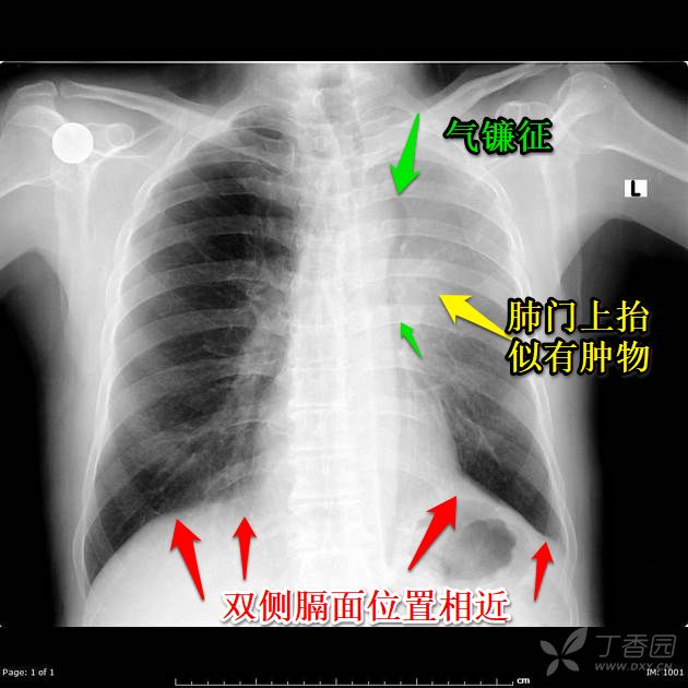 432之前我们分享了秒懂胸片!