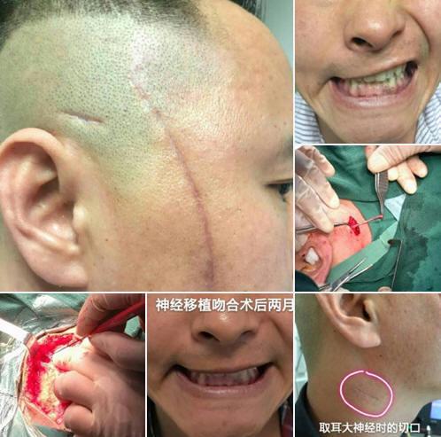 首大李健东:面部外伤,伤到面神经怎么办?